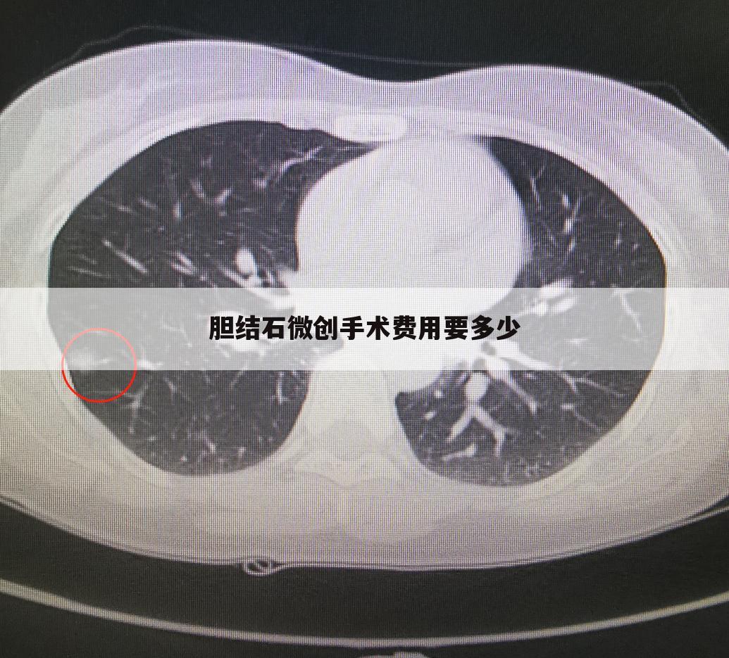 胆结石微创手术费用要多少