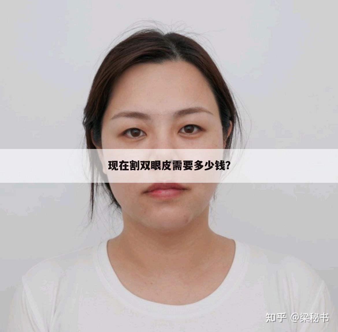 现在割双眼皮需要多少钱?