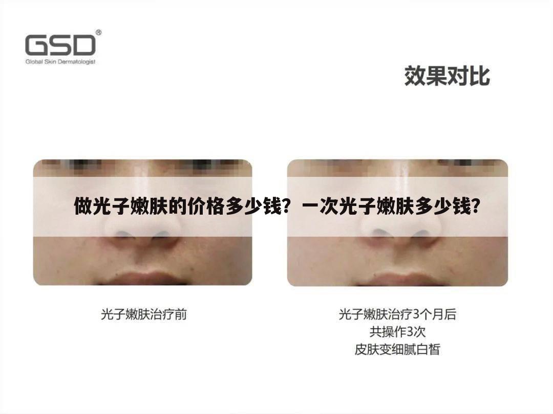 做光子嫩肤的价格多少钱?一次光子嫩肤多少钱?