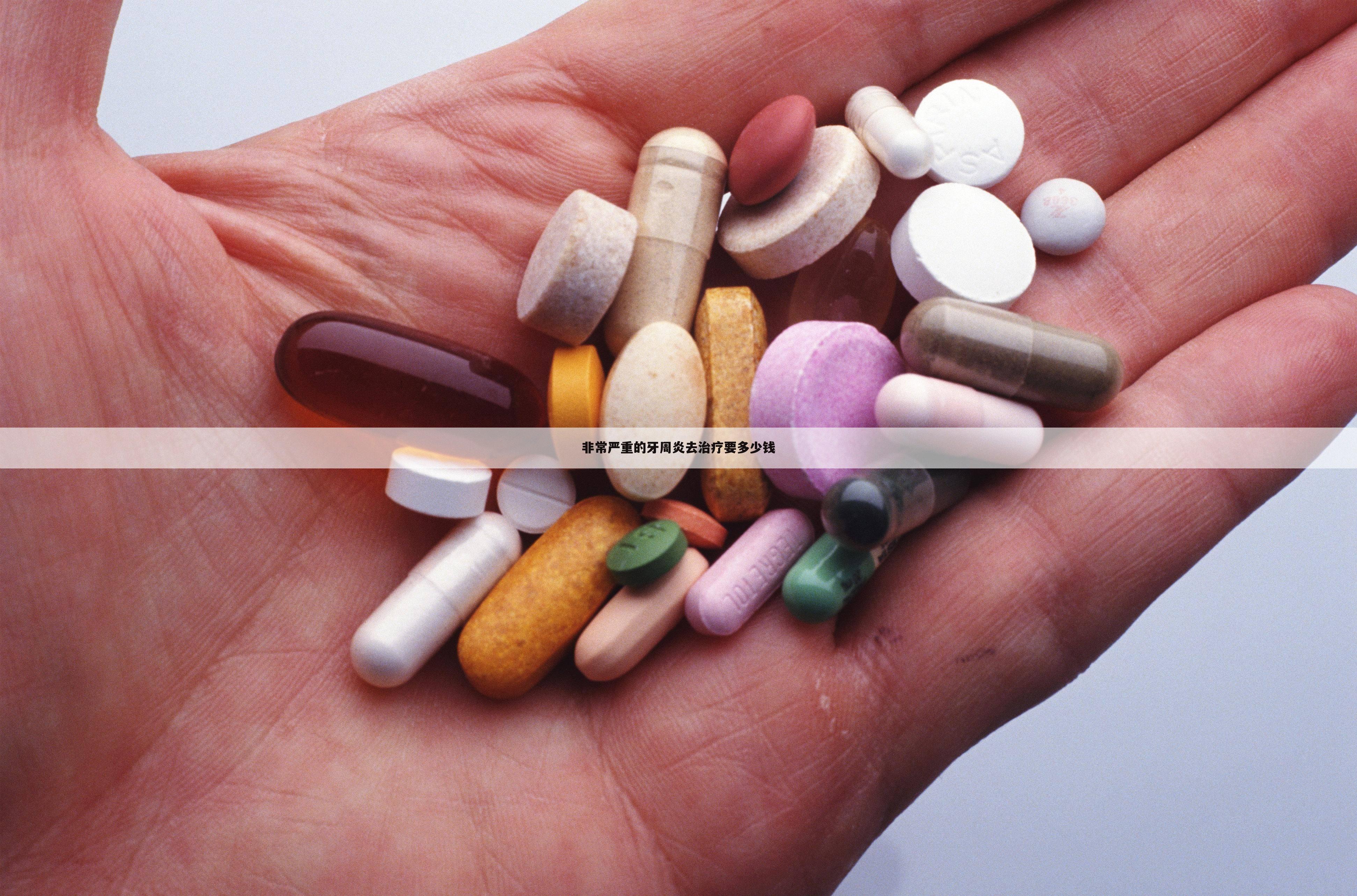 非常严重的牙周炎去治疗要多少钱