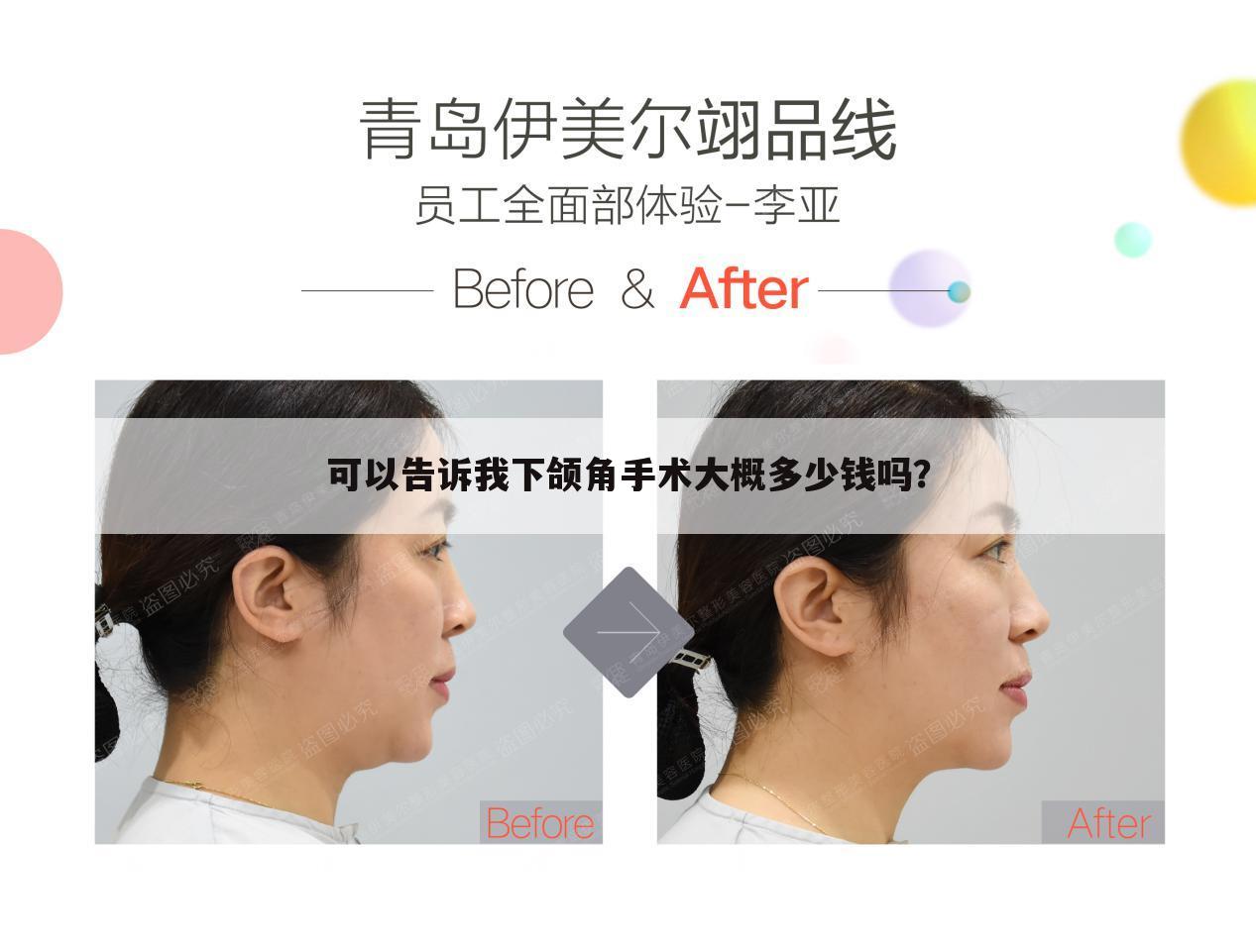 可以告诉我下颌角手术大概多少钱吗?