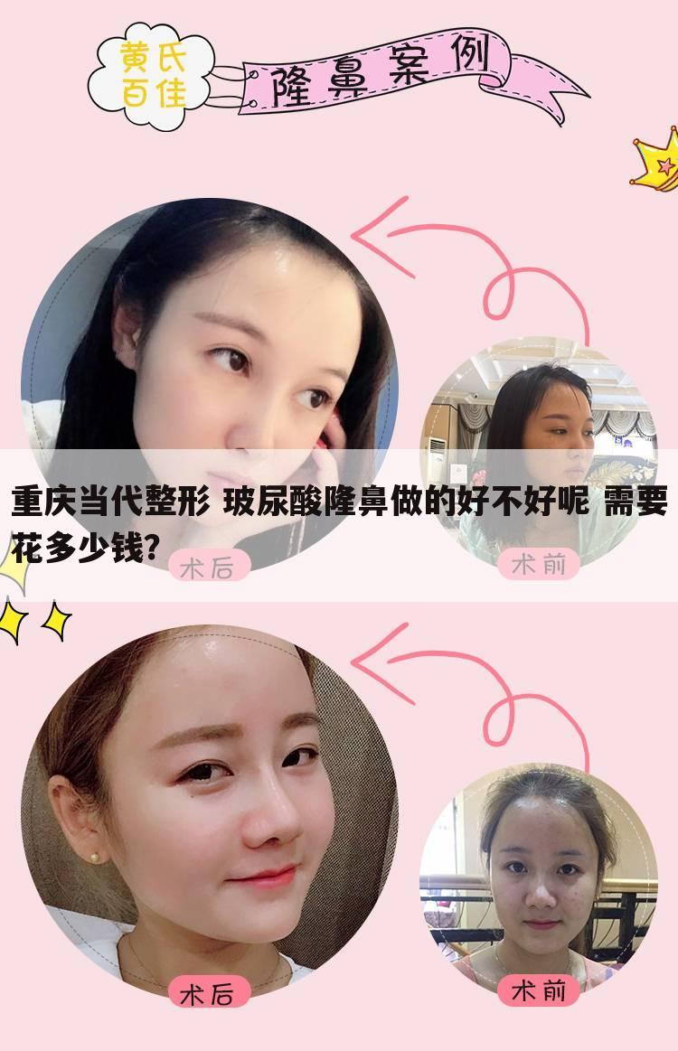 重庆当代整形 玻尿酸隆鼻做的好不好呢 需要花多少钱？