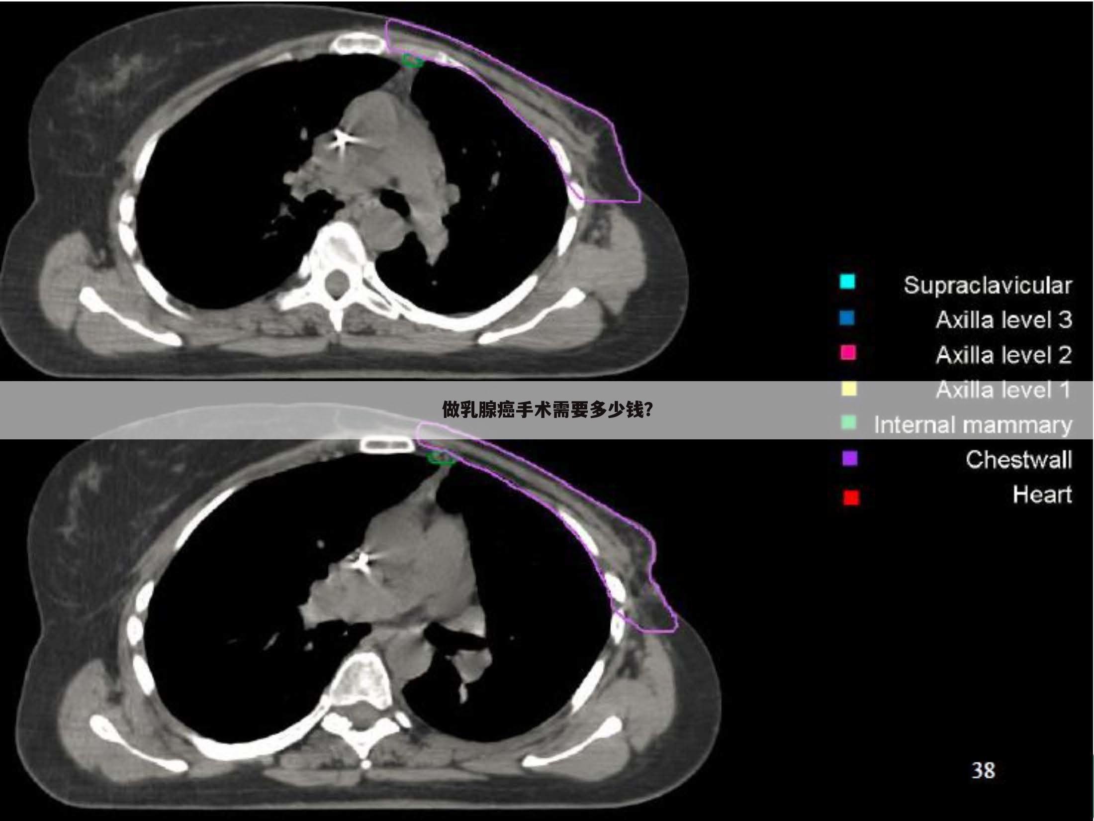 做乳腺癌手术需要多少钱？