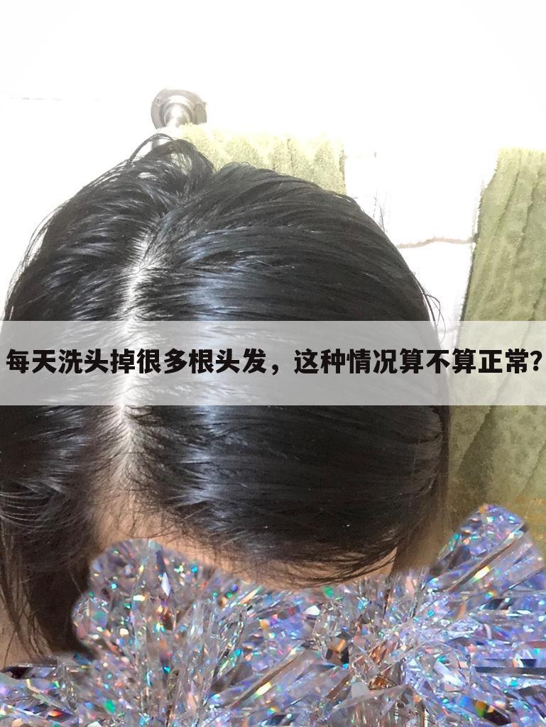 每天洗头掉很多根头发,这种情况算不算正常?