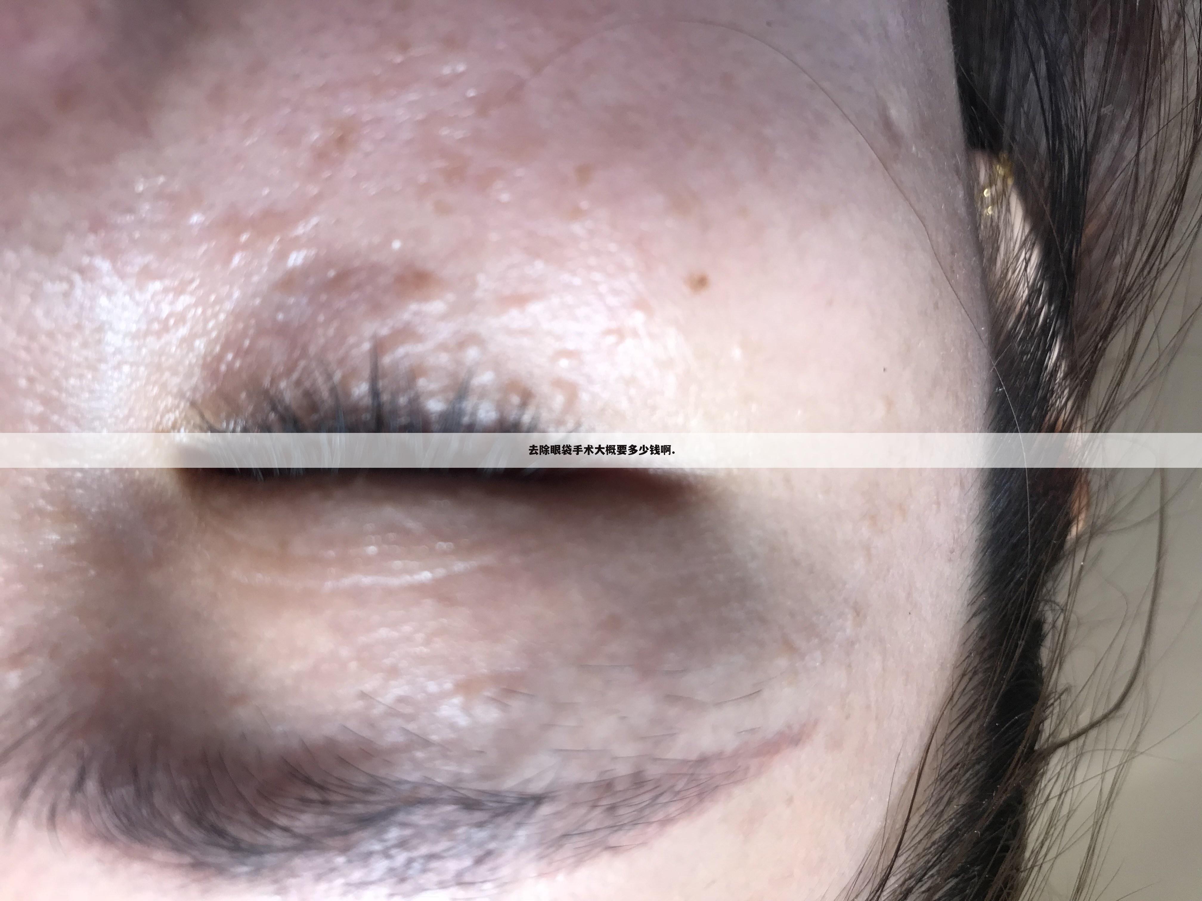 去除眼袋手术大概要多少钱啊.