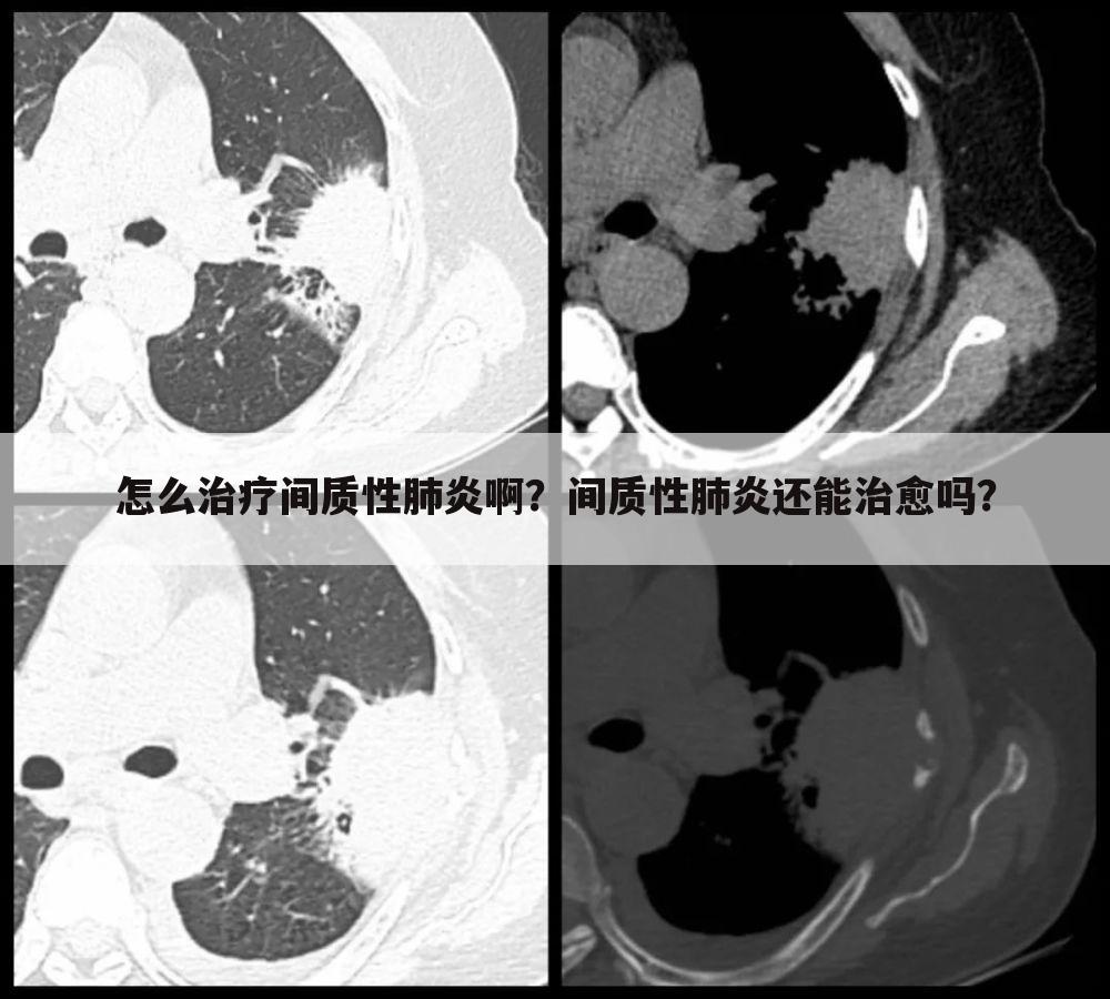 怎么治疗间质性肺炎啊？间质性肺炎还能治愈吗？