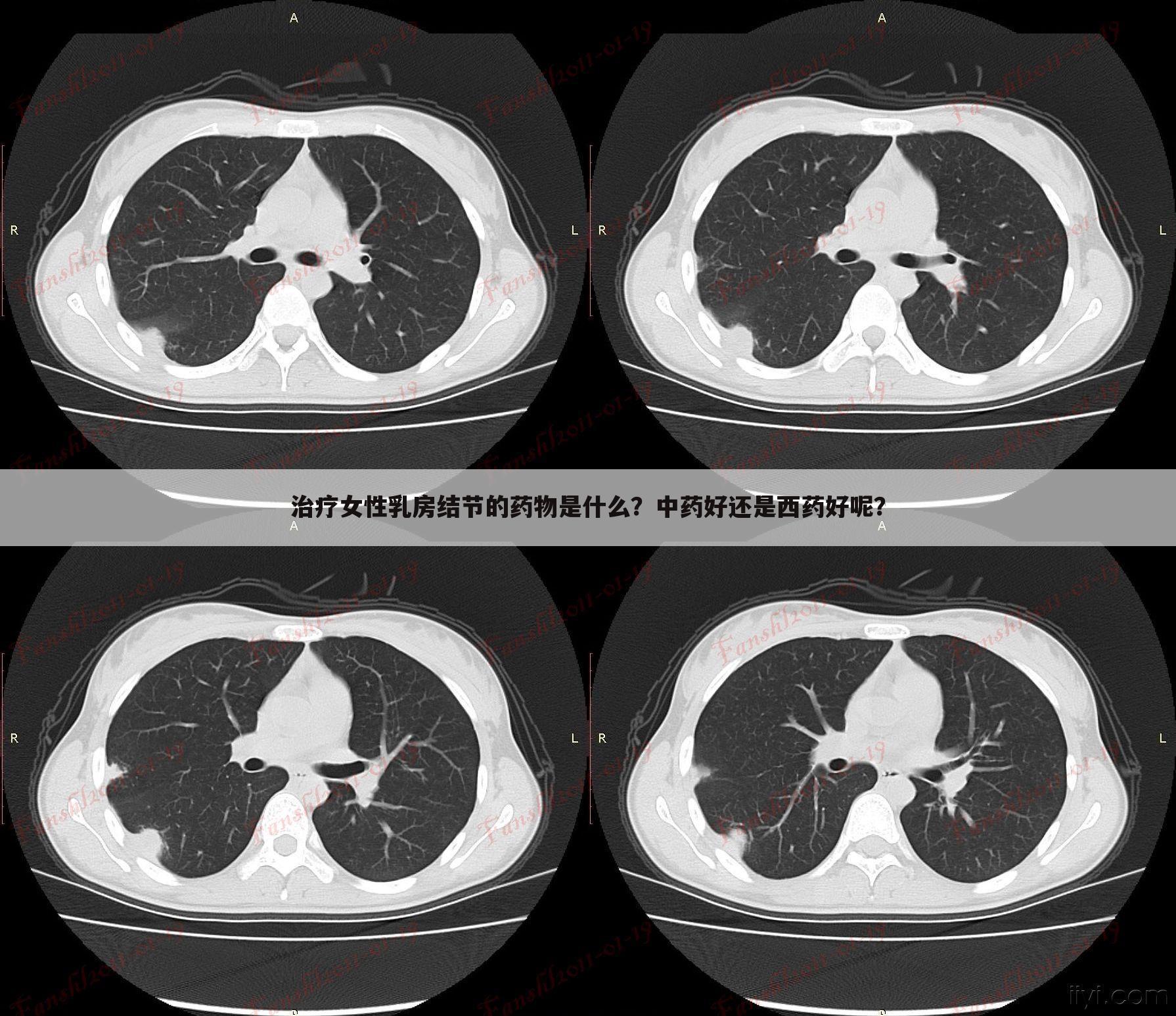 治疗女性乳房结节的药物是什么？中药好还是西药好呢？