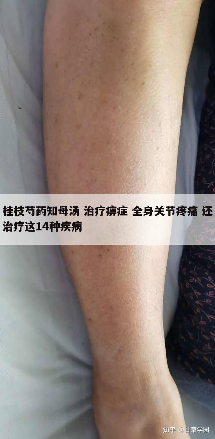 桂枝芍药知母汤 治疗痹症 全身关节疼痛 还治疗这14种疾病